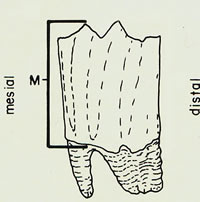 Figure 4 - Metaconid height measurement (M). Source: Todd et al., 1996.